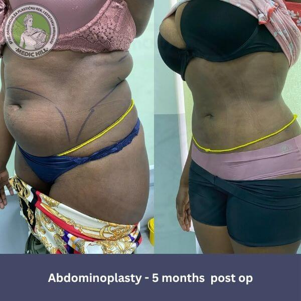 Bauchdeckenstraffung in Serbien — Beratung in einer Belgrader Klinik Medic Hill