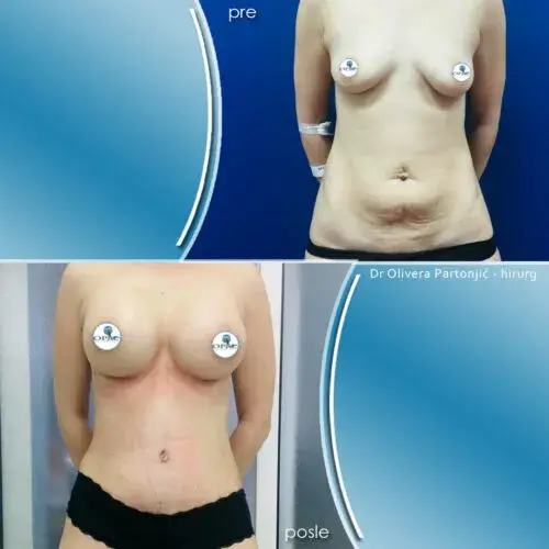 Mommy Makeover in Serbien — Beratung in einer Belgrader Klinik